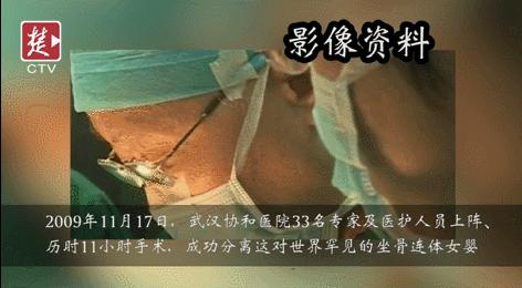 坐骨连体双胞胎多大分离,中国首例坐骨婴儿手术成功完整版