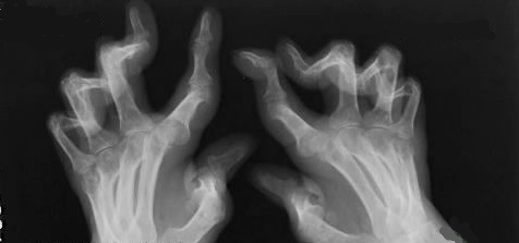 类风湿造成的关节变形可恢复吗？大多不行，有两种情况可以