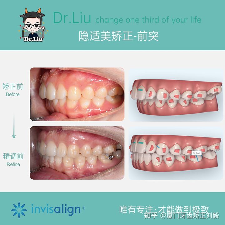拔牙正畸矫正全过程3d,拔牙嘴凸正畸的真实案例