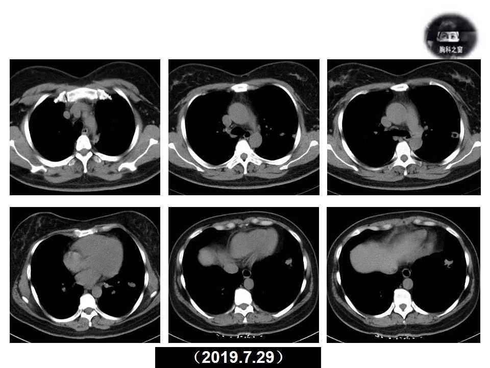 双肺多发结节是肺癌的征兆吗,双肺多发结节灶