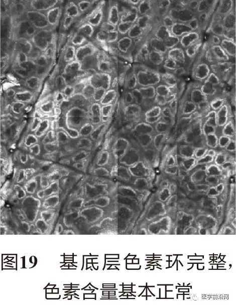 皮肤共聚焦显微镜能查什么,皮肤镜和共聚焦显微镜