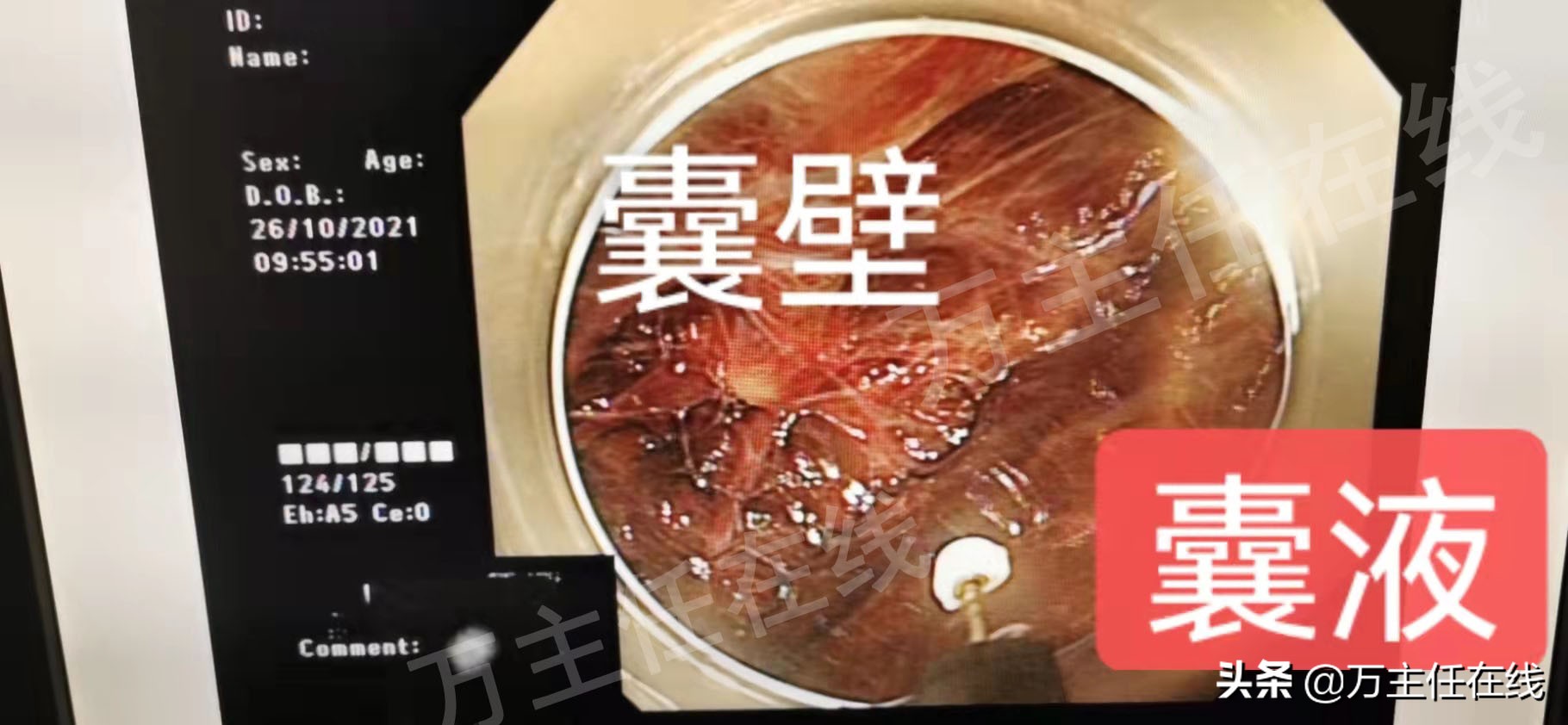 消化内科肝脏手术,肝部囊肿切除手术