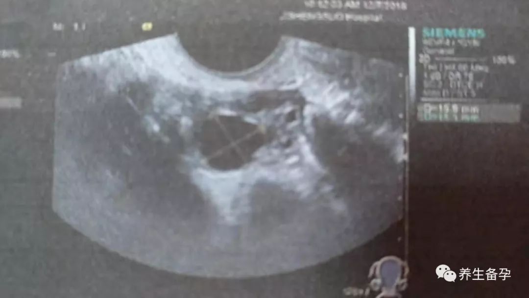 查卵泡发育做什么检查,b超监测卵泡发育不良但是怀孕了