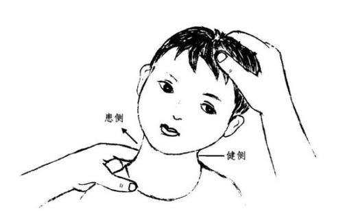 肌性斜颈手术费用,肌性斜颈的危害