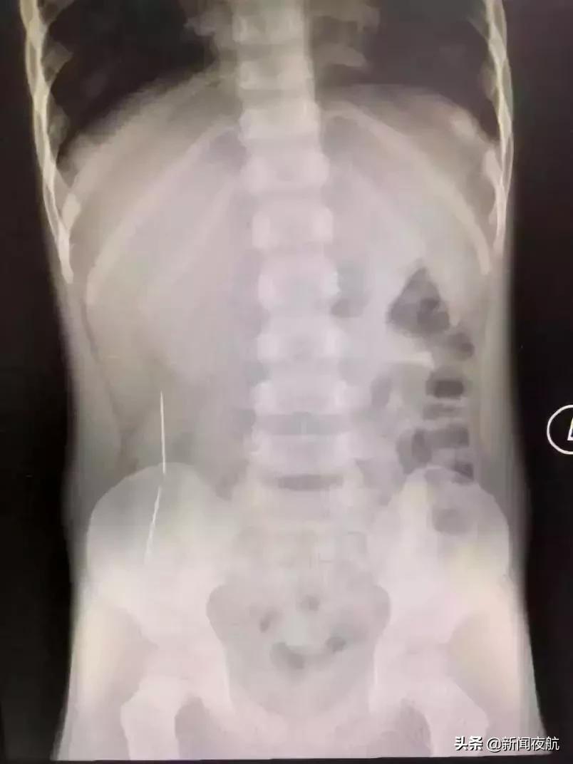 小孩误吞了玻璃碎渣有啥反应,如何判断小孩有没有误吞玻璃