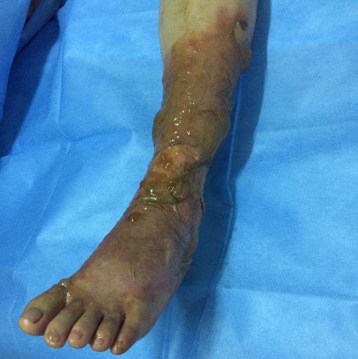 烫伤程度不同，救护措施因度而异？不同烫伤如何自救处理？