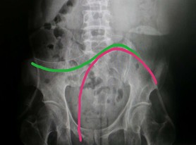 腹膜透析出现腹膜炎的护理措施,腹膜透析居家注意事项