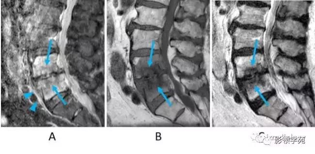 9种椎体和椎旁信号增高的非肿瘤性病变