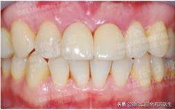 现在修复牙齿有哪几种类型的牙,牙齿修复的几种方法和价格
