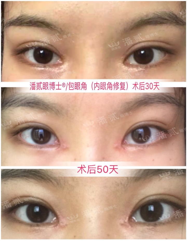 眼睛开内外眼角会过大吗,开内眼角露红肉太多了咋办