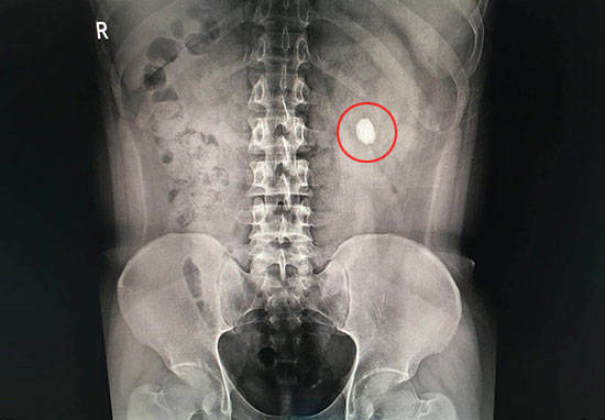 尿液发红是怎么回事正常吗,尿液发红是怎么了