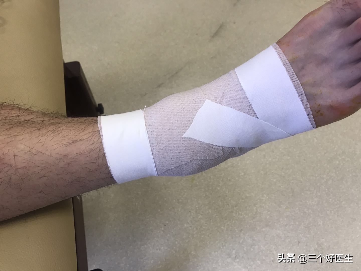 踝关节扭伤肿胀有瘀血需要弄破吗,踝关节扭伤软组织肿胀处理原则