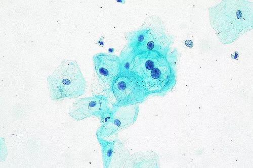 宫颈癌筛查时哪些情况需要做阴道镜？