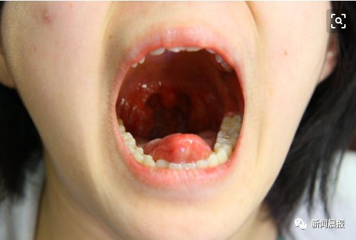 著名女歌手自曝确诊癌症晚期！这个经常发炎的器官，很多人都不当回事