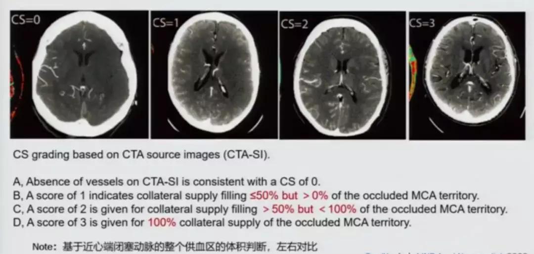 急性脑中风影像诊断选择,急性脑卒中首选哪种检查方法