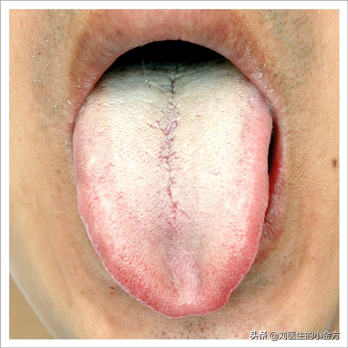 舌象图解大全中医舌诊,最全中医舌诊图谱来了