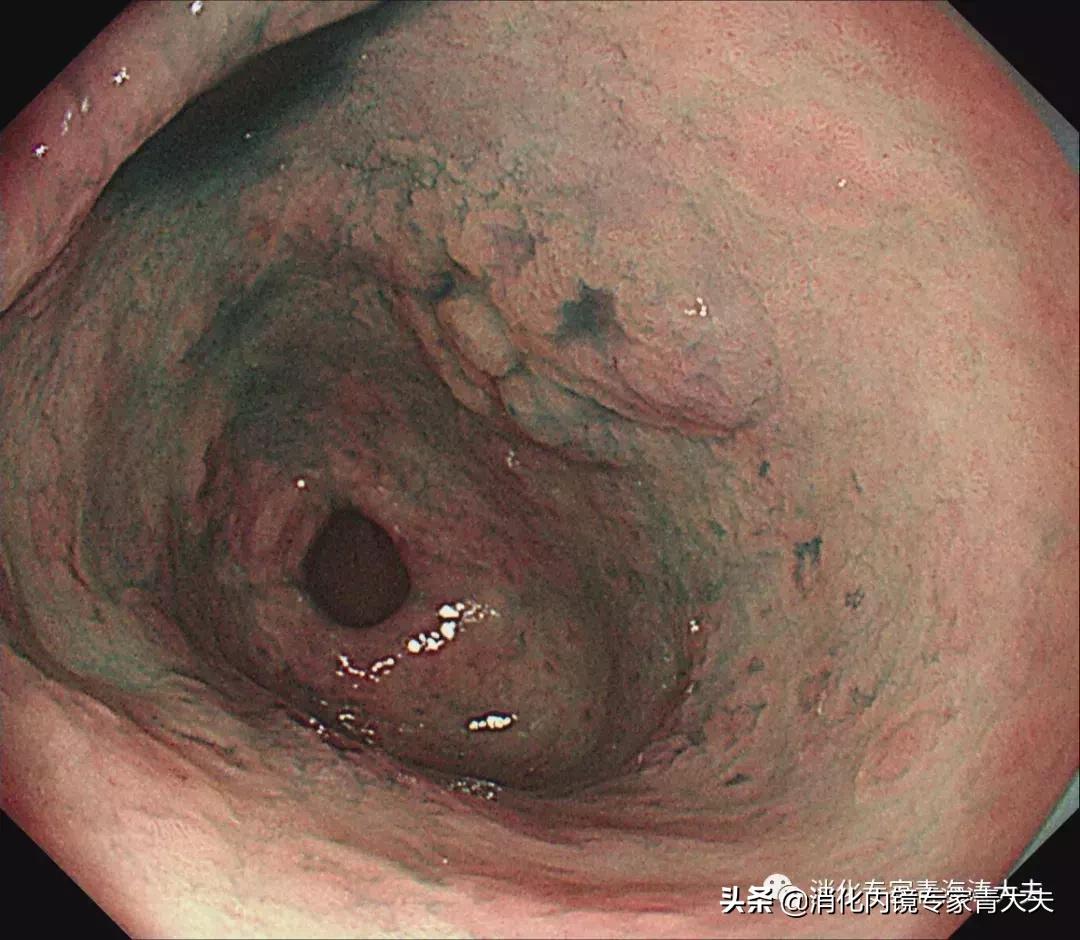 通过科普文章求治的一例胃窦后壁早癌