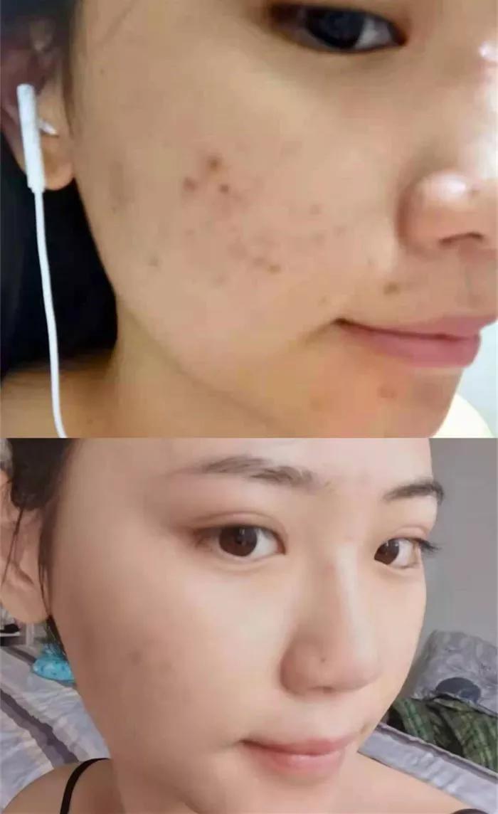 深圳治痘痘皮肤科哪个医院好啊,去皮肤科看痘痘好不好