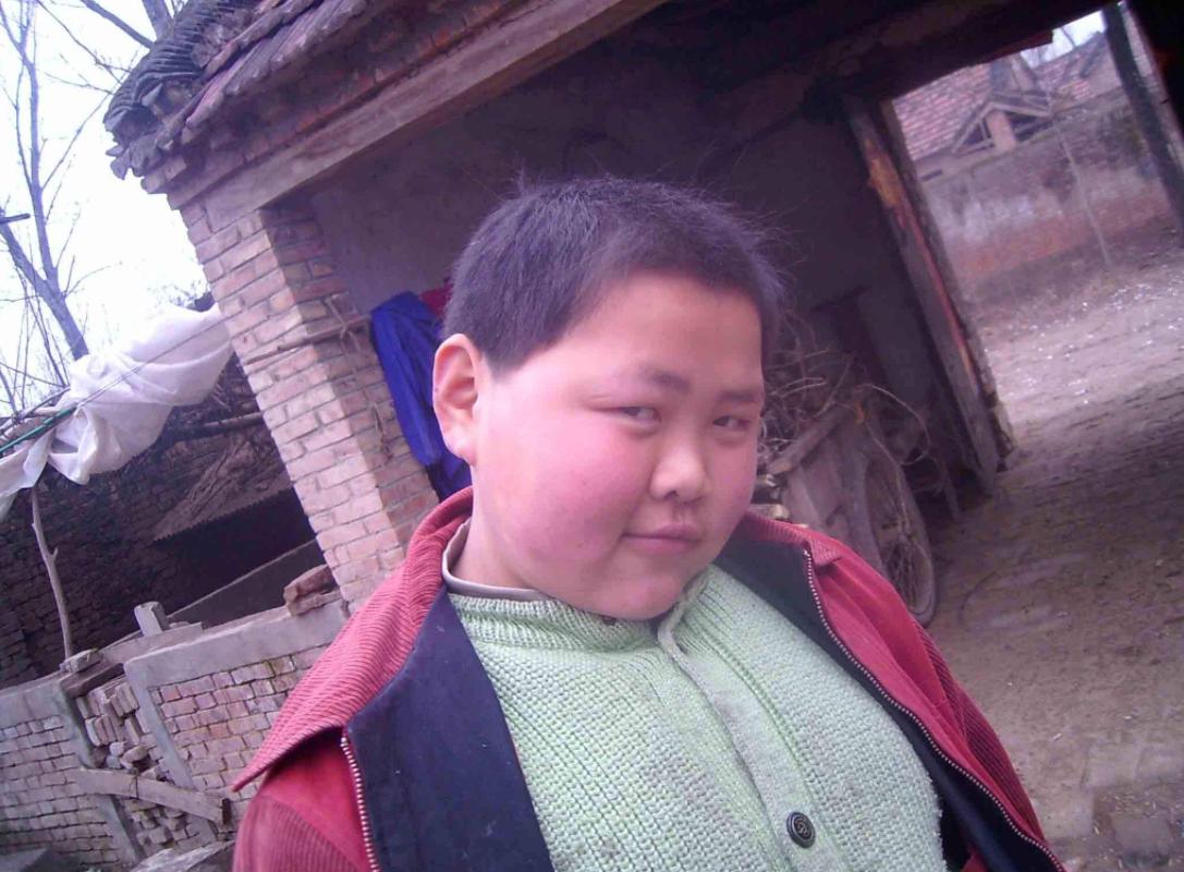 小胖威利症面容表现,小胖威利综合症是几岁开始胖的