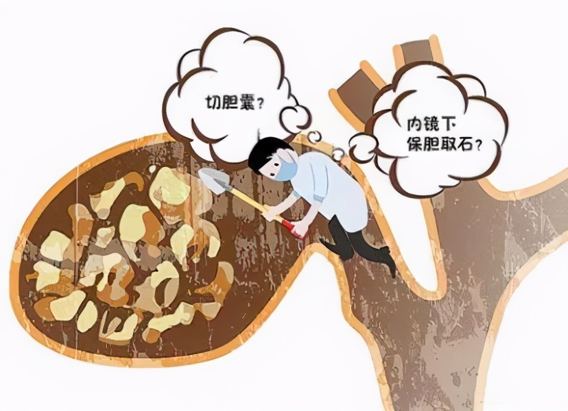 小孩胆结石可以做取石保胆手术吗,胆囊炎胆结石可以做保胆取石术吗