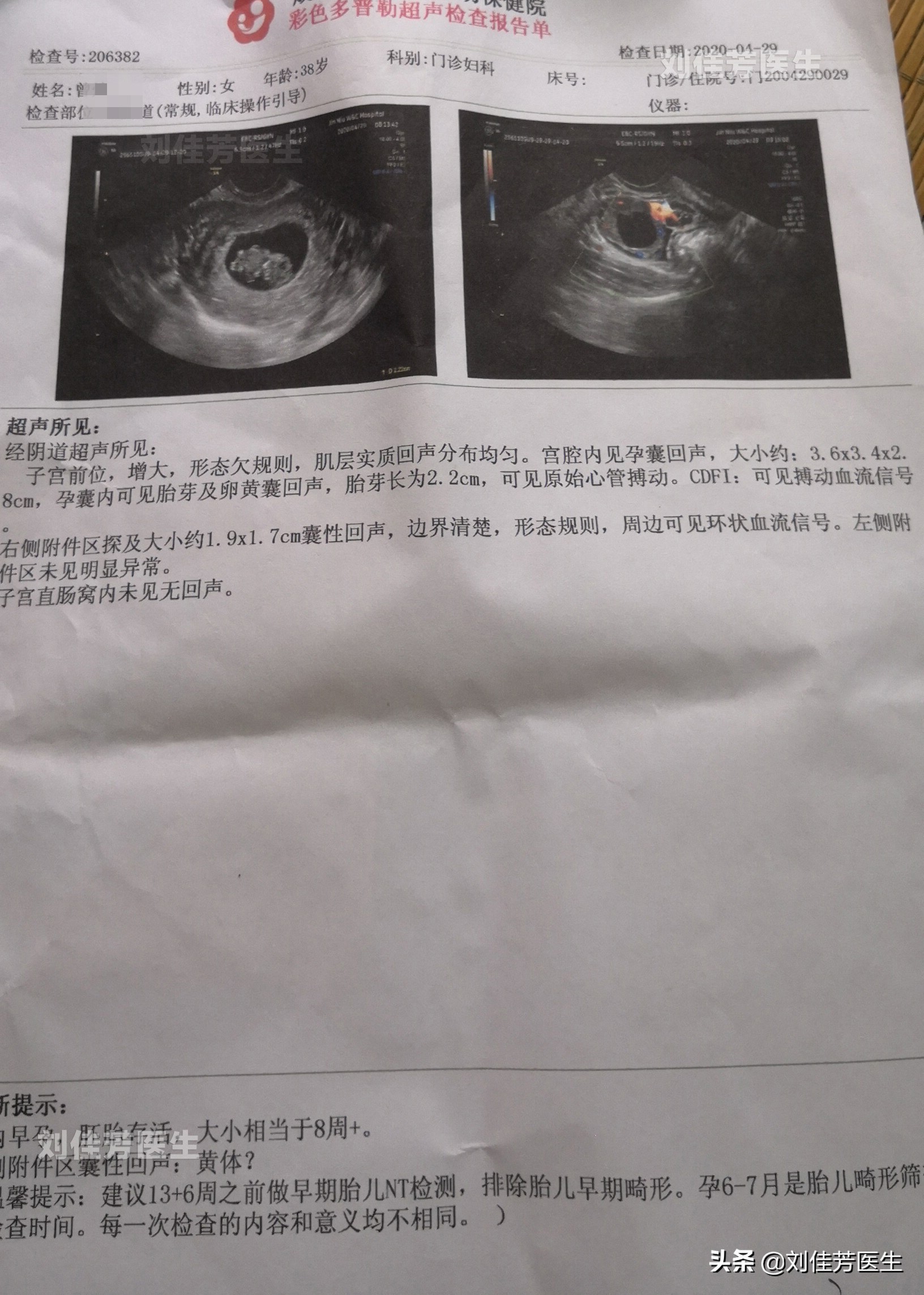 宫外孕输卵管切除后会导致多囊吗,多囊怀孕宫外孕输卵管堵了吗