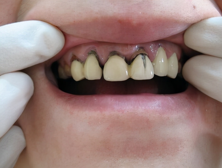 基牙会不会在烤瓷牙里烂掉,烤瓷牙怎么检查基牙坏没坏