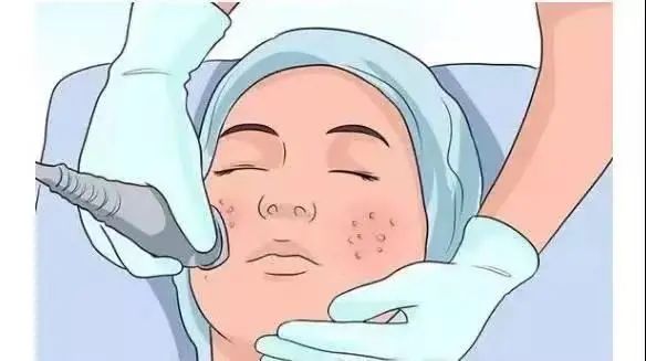 最简单最实用的去黑头方法,简单有效的去黑头方法