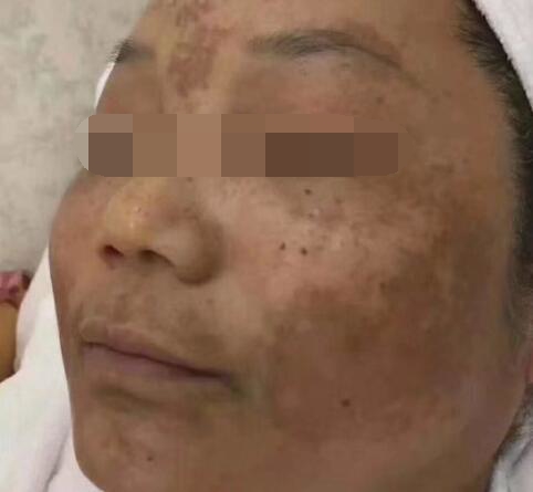 铅汞脸如何自救,那些被毁容的女孩