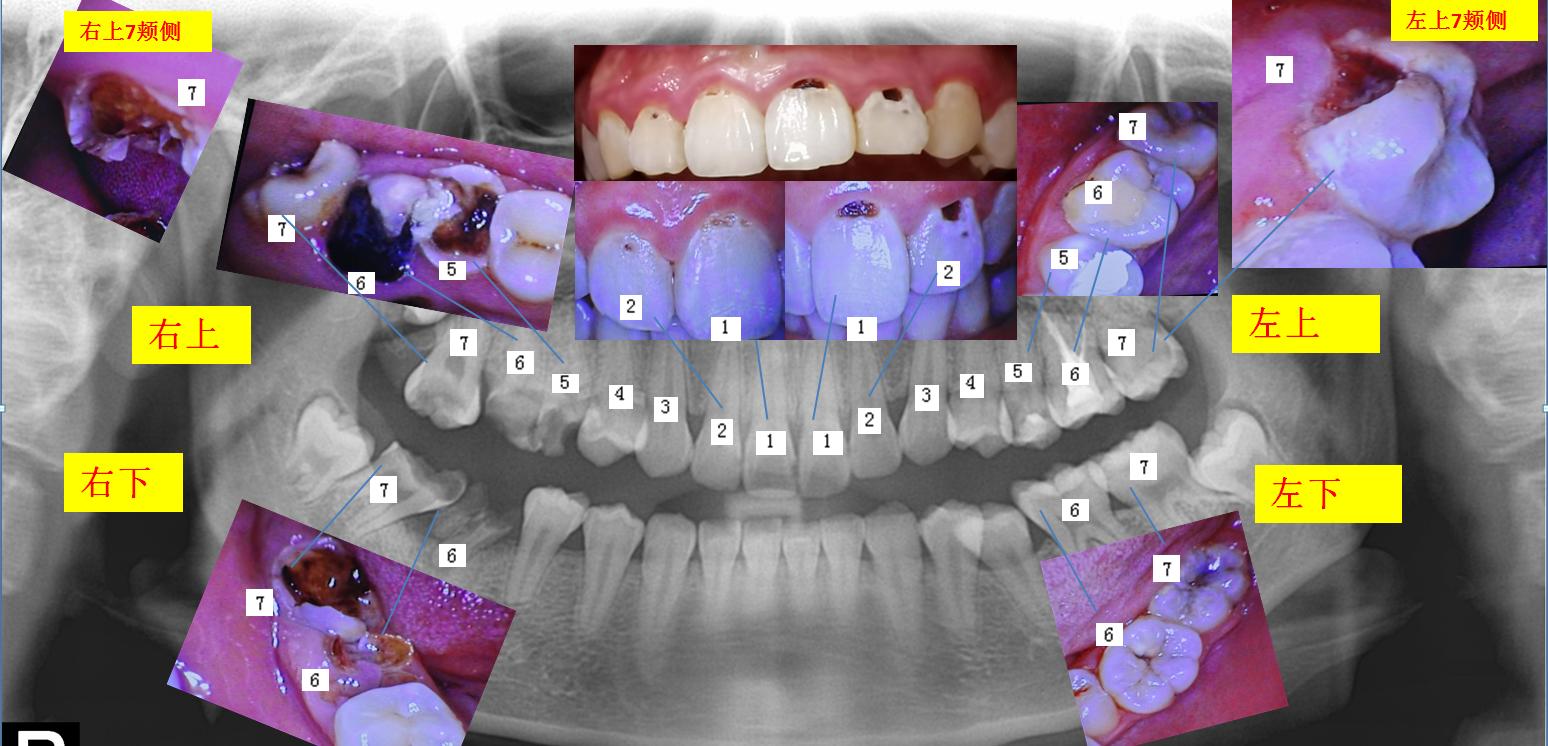 后磨牙可以矫正吗,第一磨牙龋坏可以用智齿补吗