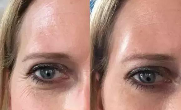 护肤黑科技顶级医美,用黑科技去除眼袋肿了十天