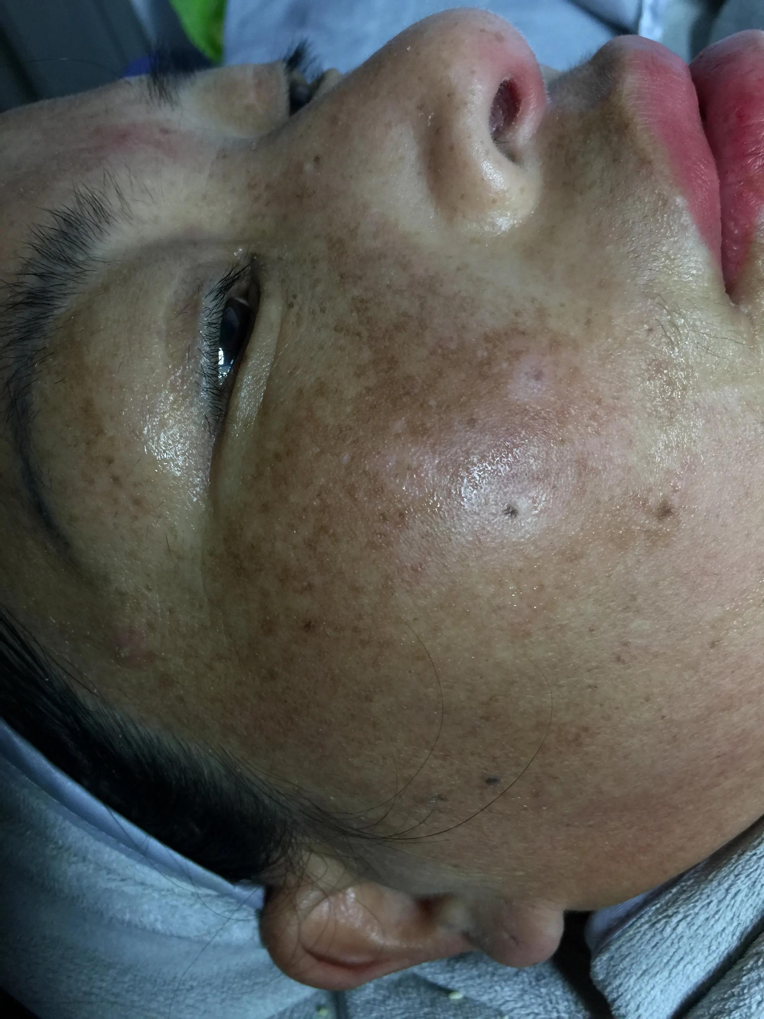 祛斑是真的吗,祛斑的是真的有效还是假的有效