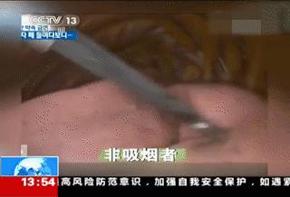 吸烟30年的肺戒烟后的变化,戒烟以后多久肺会恢复变白