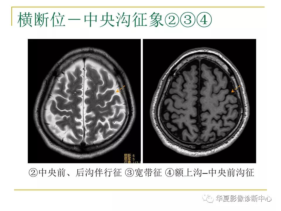 中国人脑立体定向mri应用解剖图谱,脑mri示意图