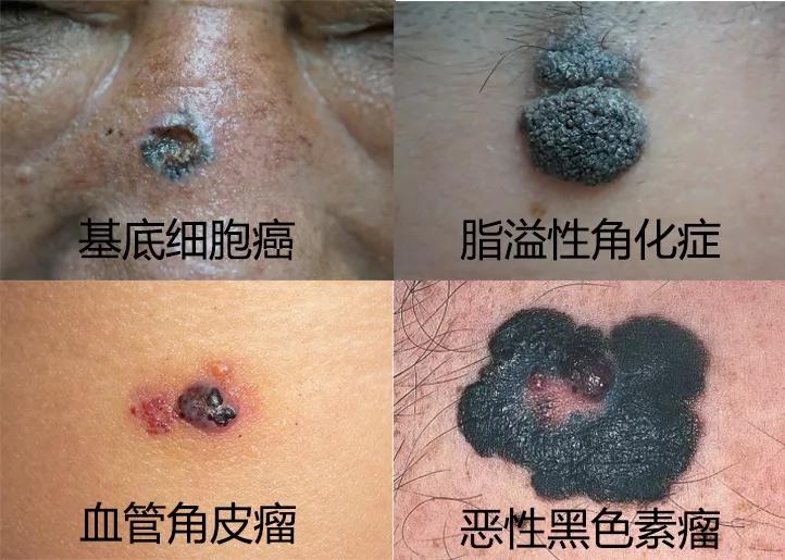 痣能点吗,我的痣凸起来会癌变吗