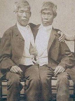 中国连体双胞胎兄弟,连体兄弟中国