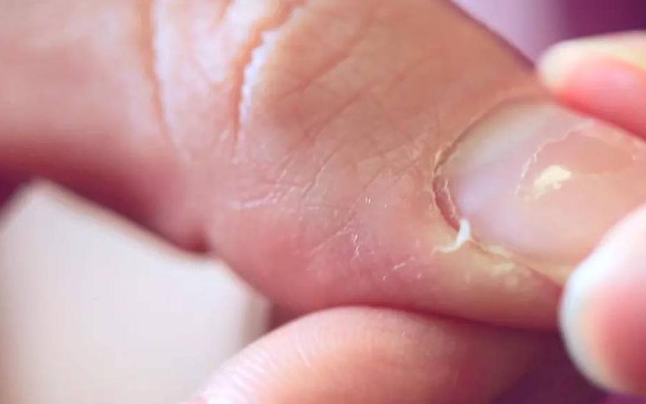 手上倒刺最简单的去除方法,预防手指生倒刺的小妙招