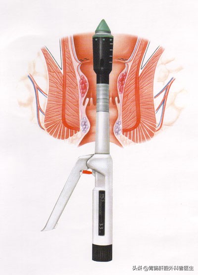 痔疮经常发作是割了好还是不割好,痔疮手术是套扎好还是传统好