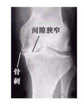 膝盖骨刺疼痛解决最好办法,膝盖骨刺疼痛怎么缓解