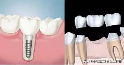 天津后槽牙种植一颗多少钱,后槽牙掉了四颗需要多少钱