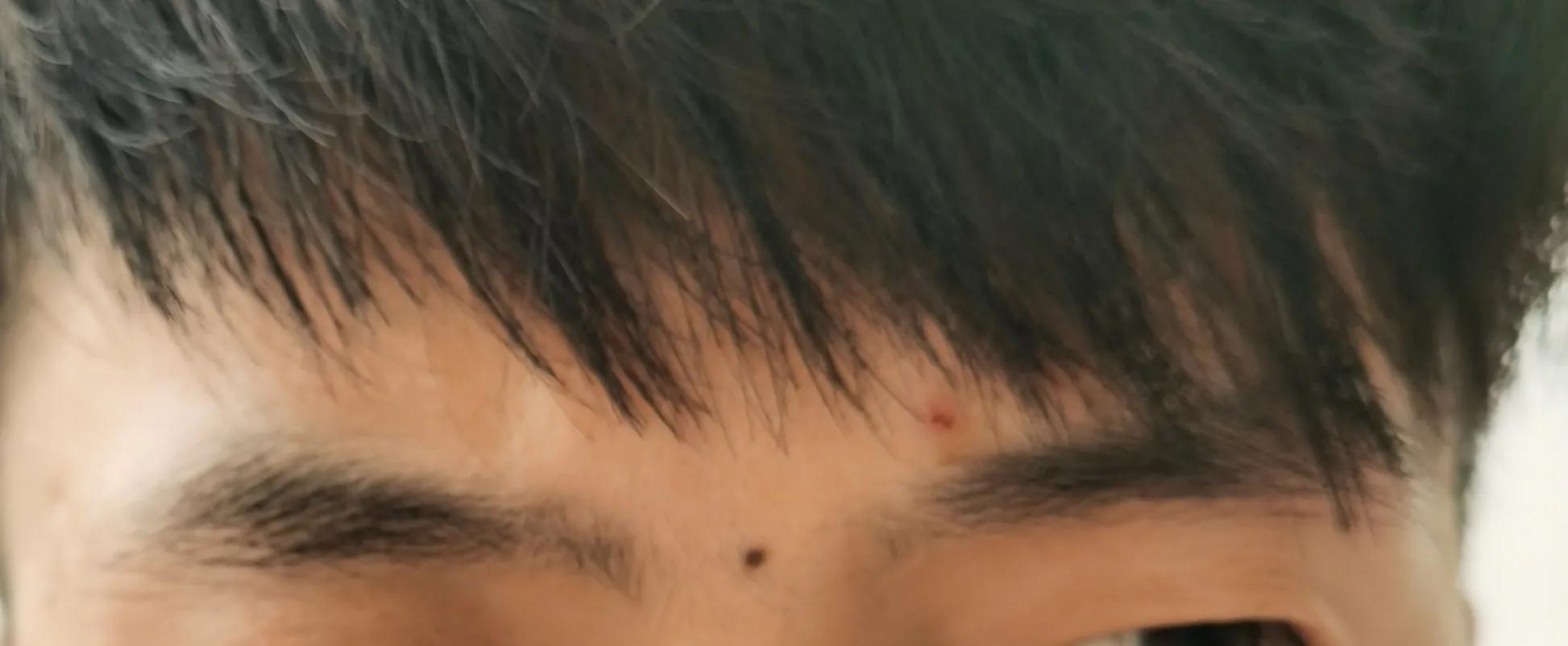 长在皮肤里面的痣激光好祛除吗,去除脸上的痣是冷冻好还是激光好