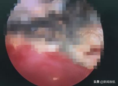 小女孩*体下**塞入异物流血不止！隔了几天走路都不对劲了