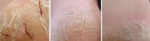 脚后跟干裂起硬皮是维生素缺少吗,脚后跟干裂能吃维生素b胶囊吗