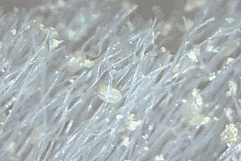 脸颊一直长痘痘闭口粉刺怎么办,脸颊长痘痘什么原因导致