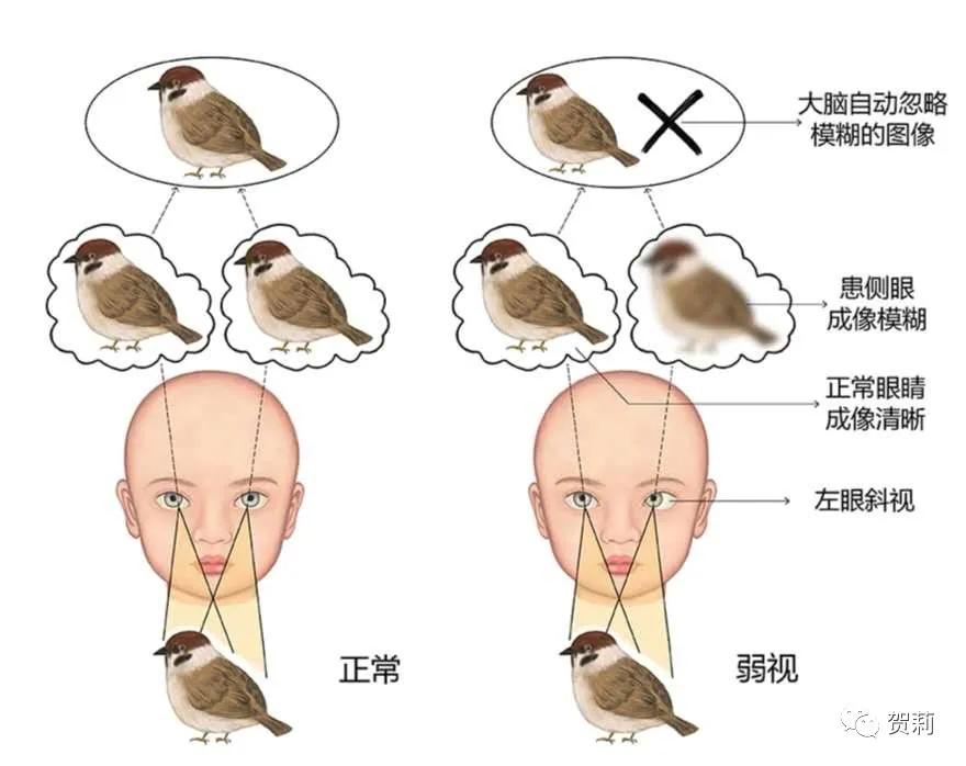 弱视最好的遮盖疗法,弱视为什么要遮盖单眼治疗