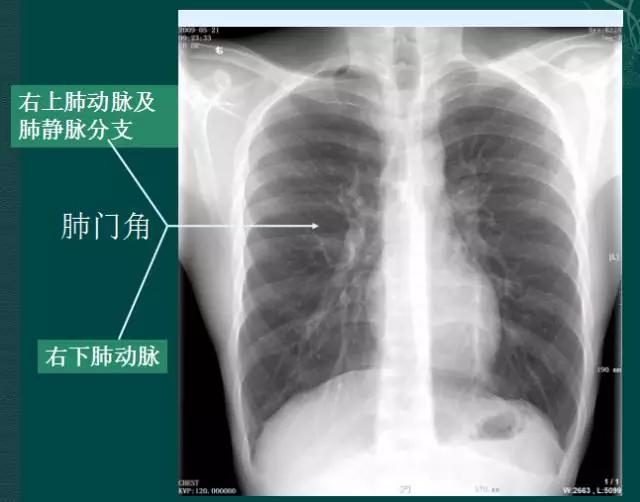 拿到胸片却不会看？送你7个窍门，手把手教你解读胸片（收藏）