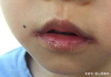 孩子嘴太干喝水也没有用怎么办,孩子喝水多嘴唇还是干怎么回事