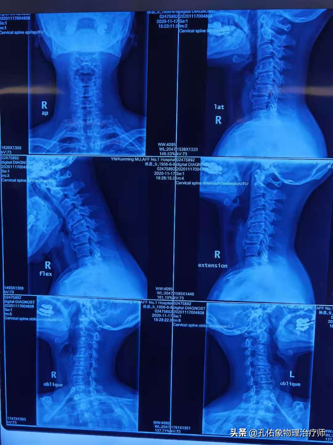 什么原因引起肩周炎手臂活动受限,引起肩周炎疼痛是什么原因