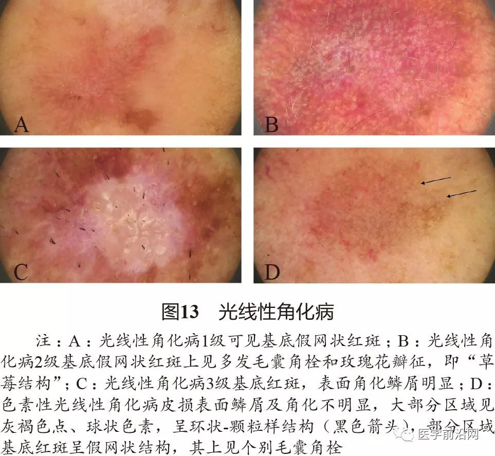 面部常见皮肤病皮肤镜诊断专家共识全文发布