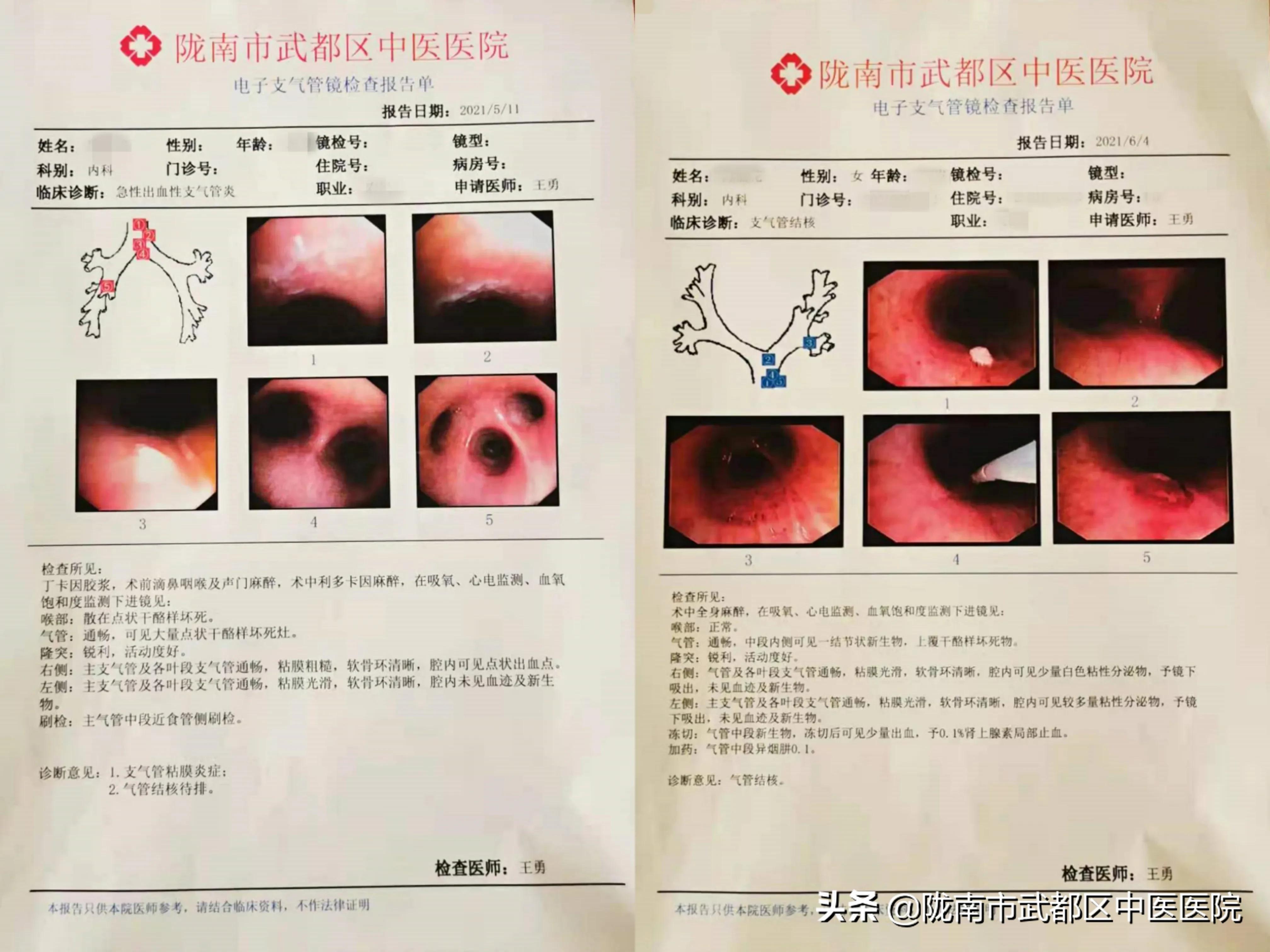 无痛支气管镜检查全过程,首例超声支气管镜