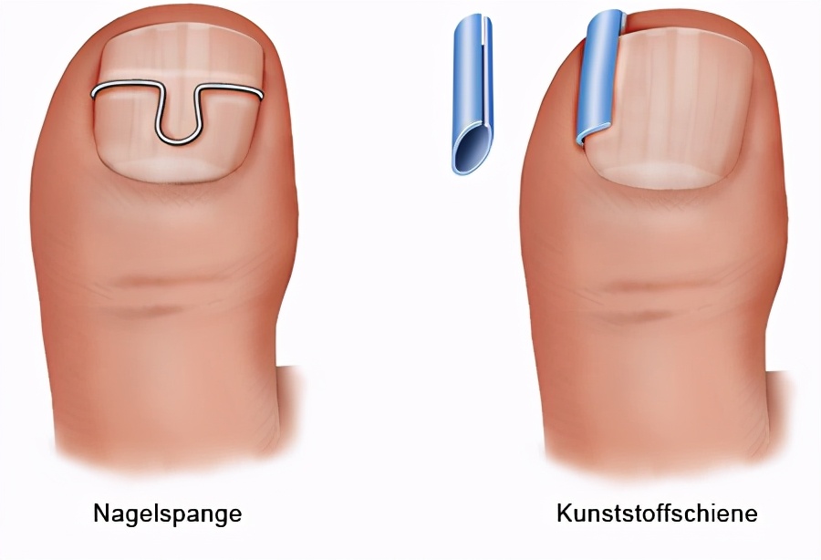 甲沟炎注意事项及禁忌,甲沟炎属于哪科疾病